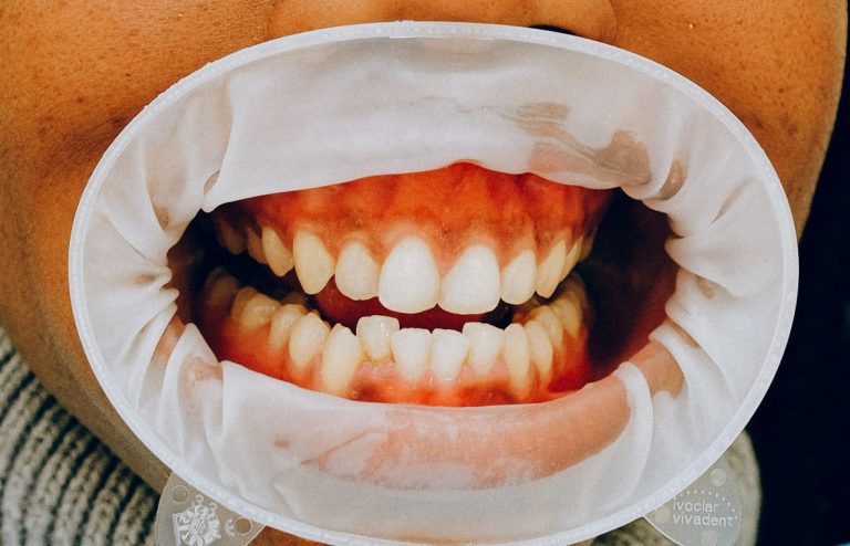 RGG_adolescenti denti bianchi